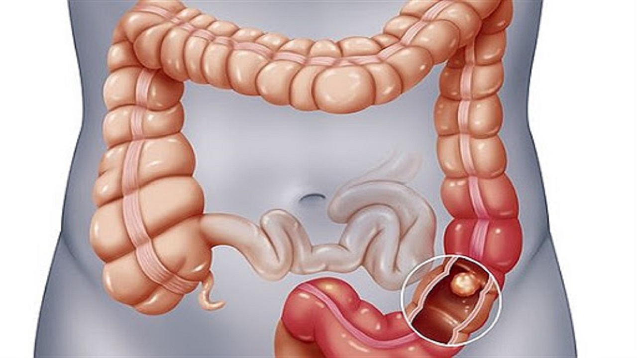 سرطان روده بزرگ دومین سرطان شایع در دنیا