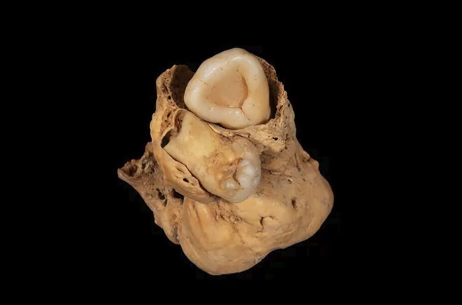 محققان در فسیل 3000 ساله یک زن مصری، توموری عجیب با دو دندان کشف کردند!