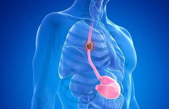 نکاتی درباره سرطان مری