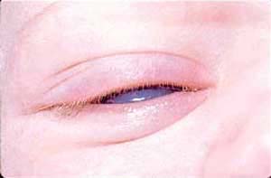 بلفارواسپاسم (Blepharospasm) 