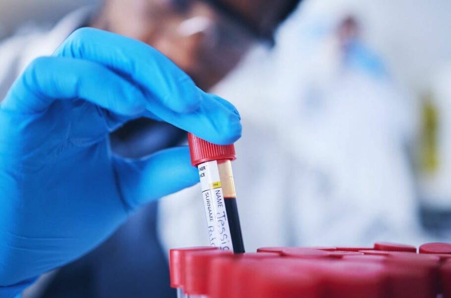 محققان: با هوش مصنوعی و یک آزمایش خون جدید می‌توان آرتروز را 8 سال زودتر پیش‌بینی کرد